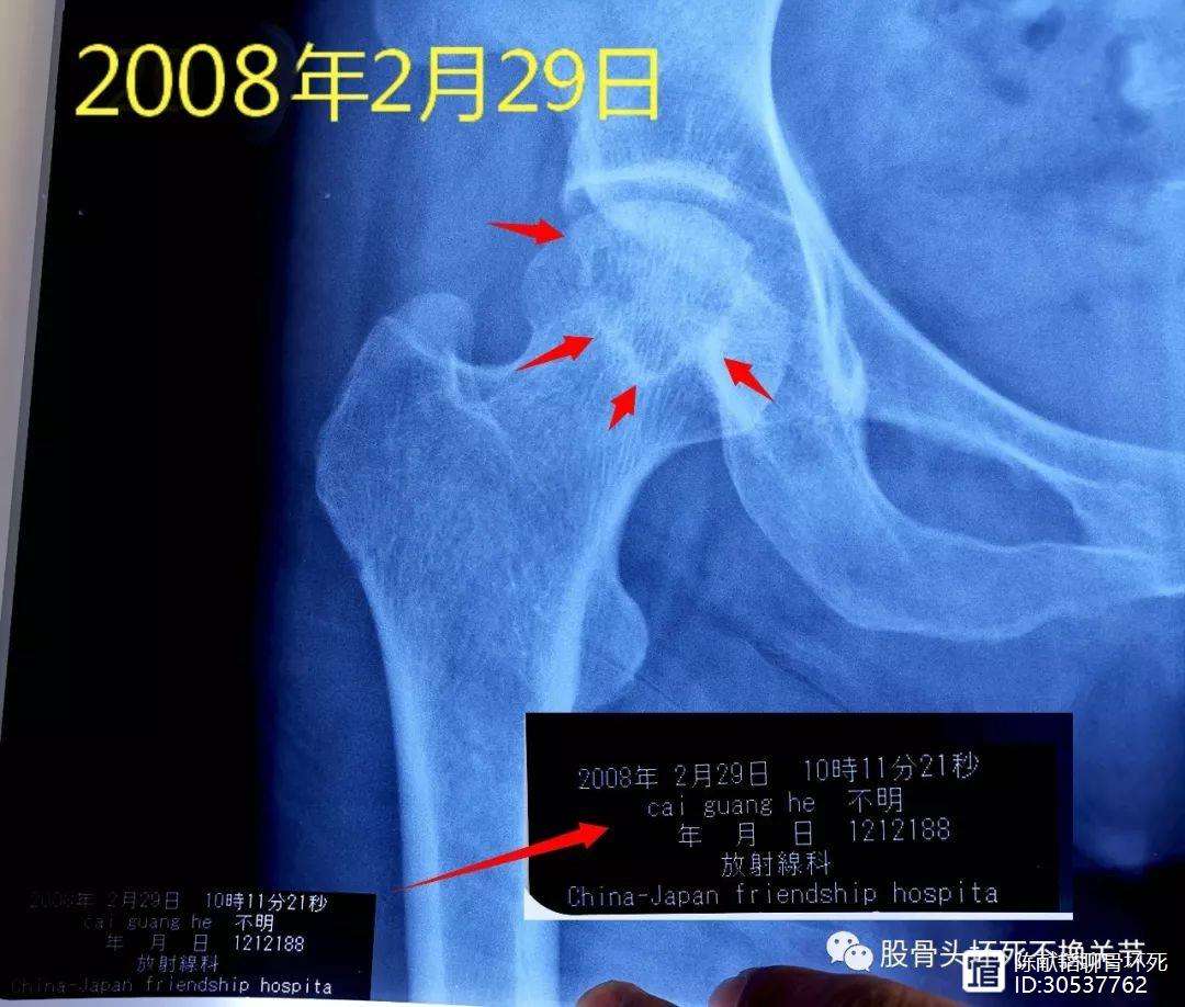 晋城人工骨头医保报销多少(人工骨头医保报销多少比例)